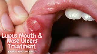 What Is Mouth Ulcer  Mouth Ulcer Symptoms  Mouth Ulcer Causes  What Is Lupus Disease [upl. by Dnilazor]