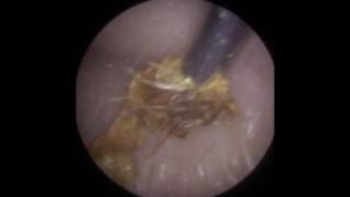 Long Strands of Ear Wax Removed using iCLEARscope®  Mr Neel Raithatha The Hear Clinic [upl. by Vevina185]