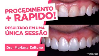 TRANSFORME SEU SORRISO Facetas e lentes de contato em resina composta Saiba tudo [upl. by Henriha581]