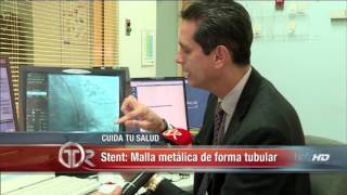 Angioplastía con colocación de Stent [upl. by Benni534]