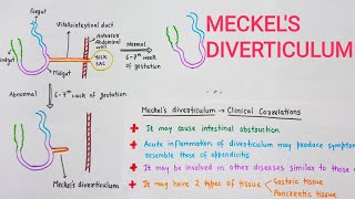 Meckels Diverticulum With Clinical Correlations [upl. by Loux]