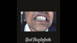 Oral prophylaxisteethcleaningbeautyofdentistryhealthygumsandteethhappysmile [upl. by Norabal]