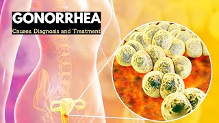 Gonorrhea Explained Symptoms Causes and Treatment Options [upl. by Eenaj]