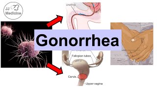 Gonorrhea Neisseria Gonorrhea  Pathophysiology Symptoms amp Complications Diagnosis Treatment [upl. by Johns]