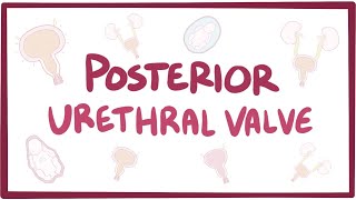 Posterior urethral valve PUV  causes symptoms diagnosis treatment pathology [upl. by Aisined]