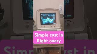 Simple cyst in right ovaryultrasound shortyoutubevideo [upl. by Joslyn]