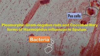 Haemophilus influenzae in Sputum  Coccobacillary forms of Haemophilus influenzae [upl. by Haines920]