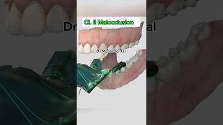 DEEP BITE CL II Occlusion Braces Orthodontics [upl. by Giralda]