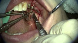 Straumann guided implant placement [upl. by Marsh]