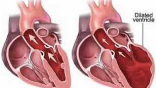 Cardiomyopathy Symptoms │ Symptoms of Cardiomyopathy [upl. by Irolav]