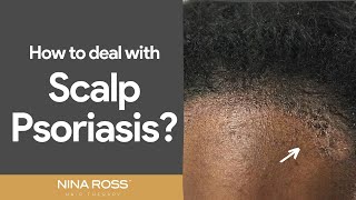 Beat Scalp Psoriasis Tips and Tricks for Relief [upl. by Barri718]