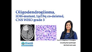 Oligodendroglioma IDH1mutant 1p19q codeleted [upl. by Anilave892]