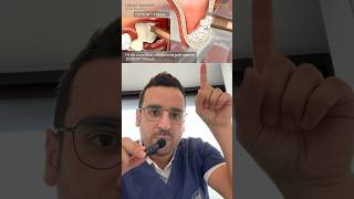 GREFFE dentaire  le clé du sinus lift avec implant [upl. by Lee]