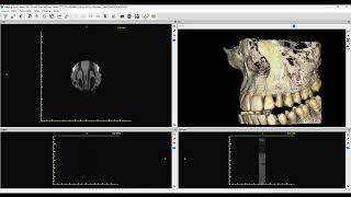 Aprimoramento da Visualização 3D  Imaging Studio e ImplantViewer 158 [upl. by Russi]