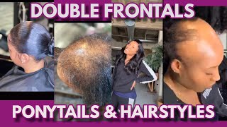 HOW TO l DOUBLE FRONTAL PONYTAILS l FRONTAL HAIRSTYLES FOR ALOPECIA amp SHORT HAIR [upl. by Fahey]