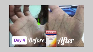 HOW TO GET RID OF WARTS AT HOME  Paano Tanggalin ang warts sa bahay [upl. by Razaile392]