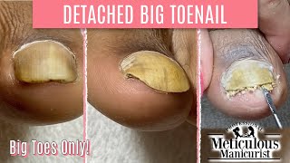 👣Big Toes Only  How To Pedicure Transformation for Men on Detached Toenails👣 [upl. by Newcomb]