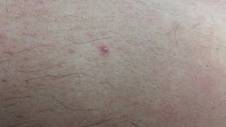 Encapsulated Ingrown Hairs [upl. by Thomasine773]