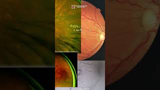 White Dot Syndromes ophthalmology optometry uveitis eyedisease choroidopathy [upl. by Htenaj]