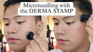 Acne Scar Treatment using Derma Stamp from Banish [upl. by Notnert409]