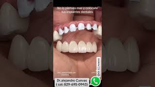 Quien aplica para tener sus dientes individuales con implante dental shortsvideo dentista fypシ゚ [upl. by Altheta]