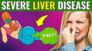 17 SIGNS that your LIVER is DYING  DANGEROUS [upl. by Cia474]