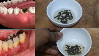 Tooth Ache Use this Clove Oil and you will not need the Dentist [upl. by Massey]