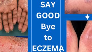 Management guidelines of eczema skin specialist advice How to treat eczemaskinhealthvitality5959 [upl. by Negriv125]