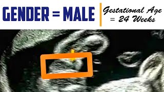 Male Fetus on Ultrasound  Gender Identification at 24 Weeks Scan [upl. by Bartholomew]