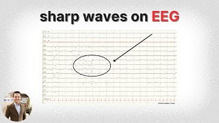 Learn EEG Positive Spikes and Sharps [upl. by Ashraf]