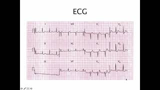 58 EKG case ST T change  ករណីសិក្សារECGលើអ្នកជំងឺមានការប្រែប្រួល ST T [upl. by Michale]