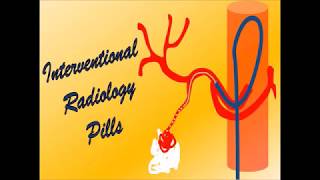 Percutaneous endovascular embolization of a gastrointestinal bleeding [upl. by Alleiram739]