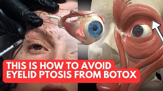 Avoid Eyelid Ptosis From Botox Treatments with THIS Anatomy Knowledge [upl. by Elbam]