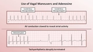 Intro to EKG Interpretation  How to Identify Any Tachyarrhythmia with 6 Easy Questions [upl. by Letnahs]