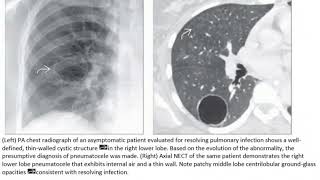 Pneumatocele radiology [upl. by Riancho]