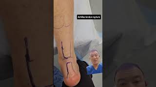 What an Achilles Tendon Rupture Looks Like on the Operating Table  PreSurgery Insights [upl. by Helli809]