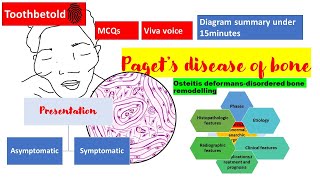 Pagets disease of bone  RadiographHISTOPATHOLOGYclinical features  NBDENEET MDSBDS  Diagrams [upl. by Hennessey464]