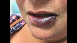 Venous Malformation of the Lower Lip  How We Treated This Patient [upl. by Mignonne87]