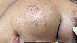 ACNE TREATMENT VU QUYNH MI  Perennial Blackheads On Boy Face 2024FULL [upl. by Hsepid]