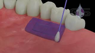 3D Demonstration  PeriAcryl®90 [upl. by Appel]