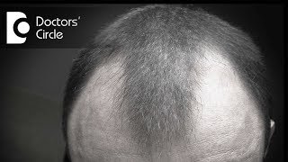 Can minoxidil be helpful in treating bald patches in young men  Dr Rasya Dixit [upl. by Rubinstein]