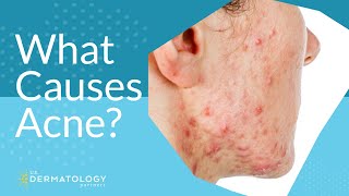 What Causes Acne  Explained by Dermatologist [upl. by Assilat]