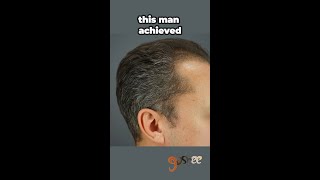 Hair Loss 10 Month Transformation [upl. by Ilrebmyk]