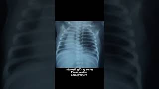 Newborn Xray l Interesting Xray seriespause review and comment nicu [upl. by Lodnar664]