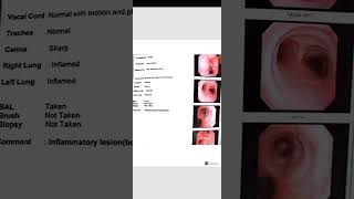 Bronchoscopy  inflammatory lesion [upl. by Rogers]