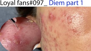 Acne Treatment Huong Da Nang 097  Loyal fans  Part 1 [upl. by Belshin]