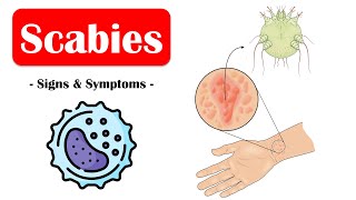 Scabies  Signs amp Symptoms What Are The Commonest Signs amp Symptoms Of Scabies [upl. by Amaris]