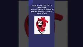 ATHEROSCLEROSIS nclex rn nursing nursingfoundation atherosclerosis healthawreness medical [upl. by Ahsekal]