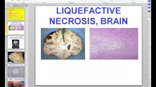 Medical School Pathology 2012 Session 003 Cell Adaptation Injury Death Lecture and Labmp4 [upl. by Oinotnanauj]