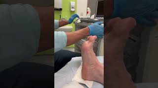 Painless Steroid injection for plantar fasciitis by ultrasound guidance [upl. by Rigby]